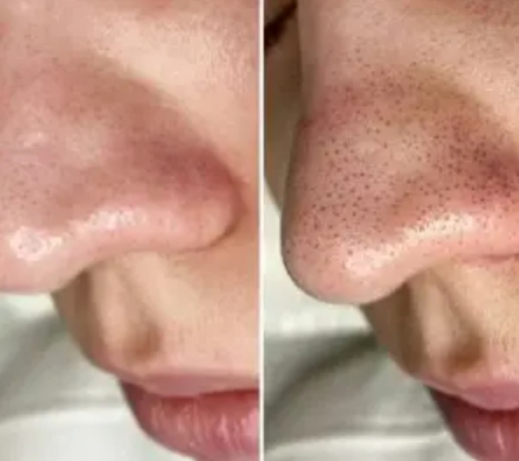 فشیال و پاکسازی تخصصی پوست