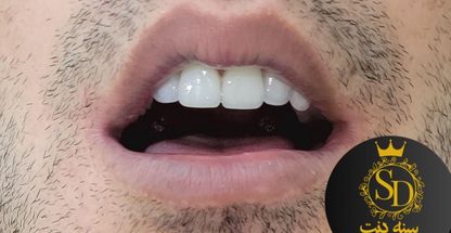 دندانسازی سنه دنت