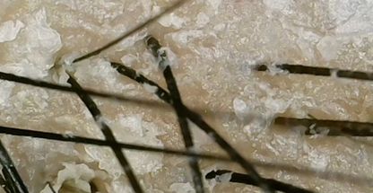 اسکراب اسکالپ(پاکسازی کف سر)