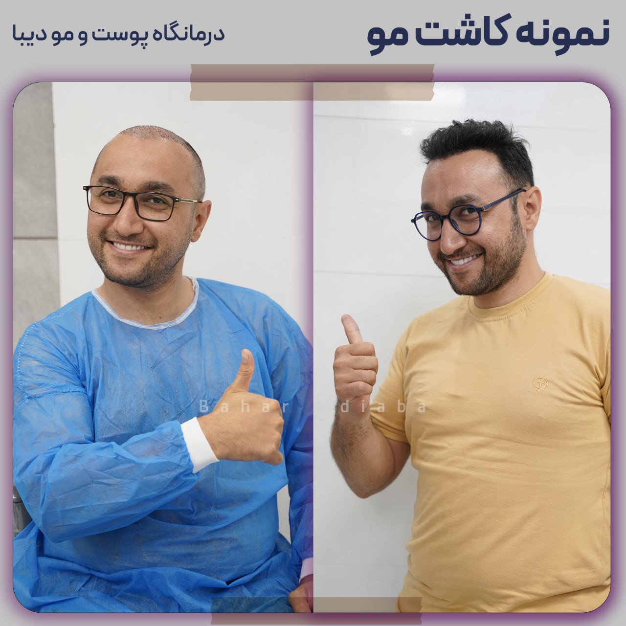 کلینیک کاشت مو دیبا