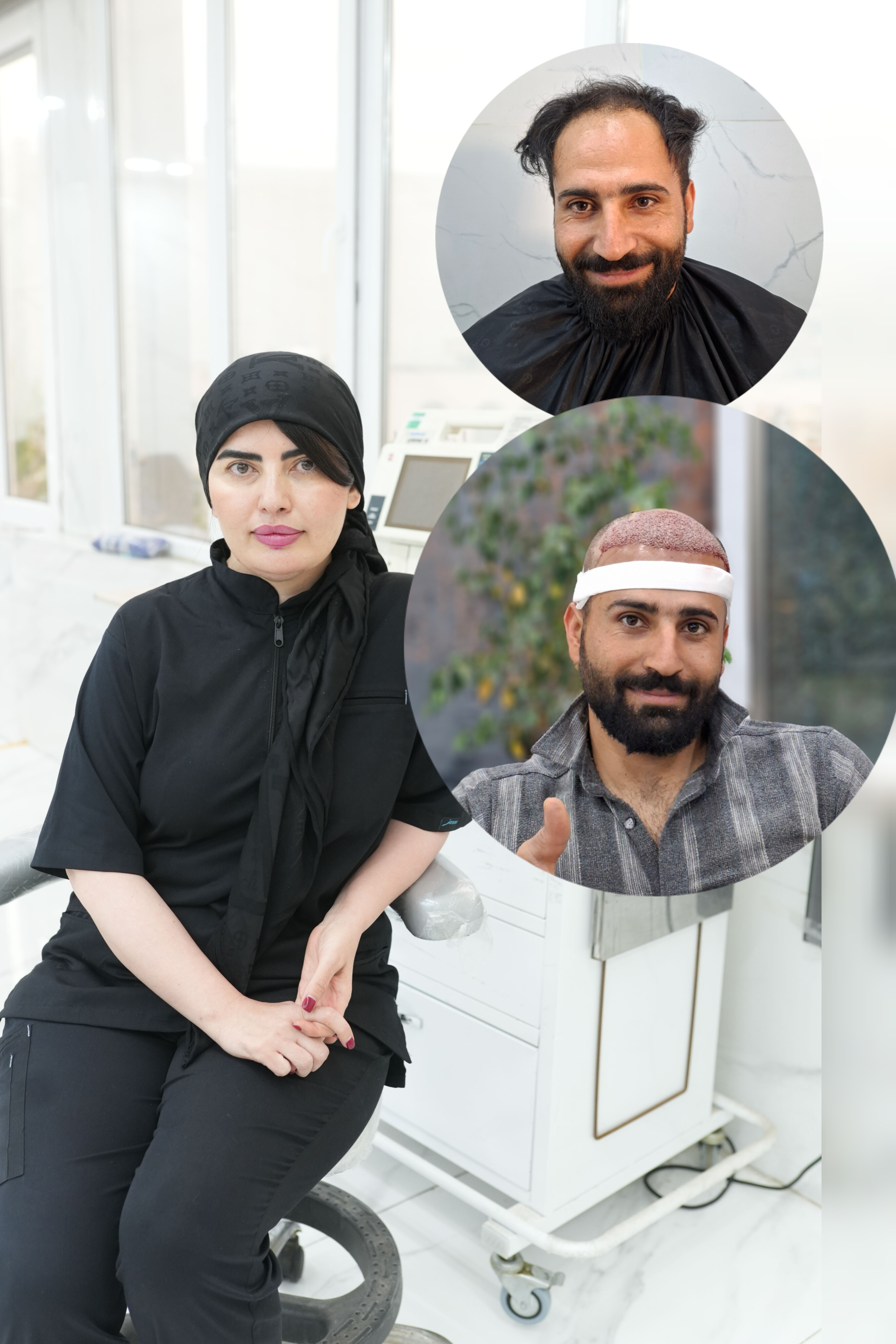 کاشت مو به روش سوپرمیکروگرفت
