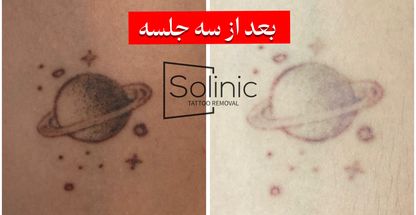 لیزر تتو سولینیک