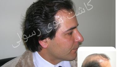 کلینیک کاشت موی رسولی