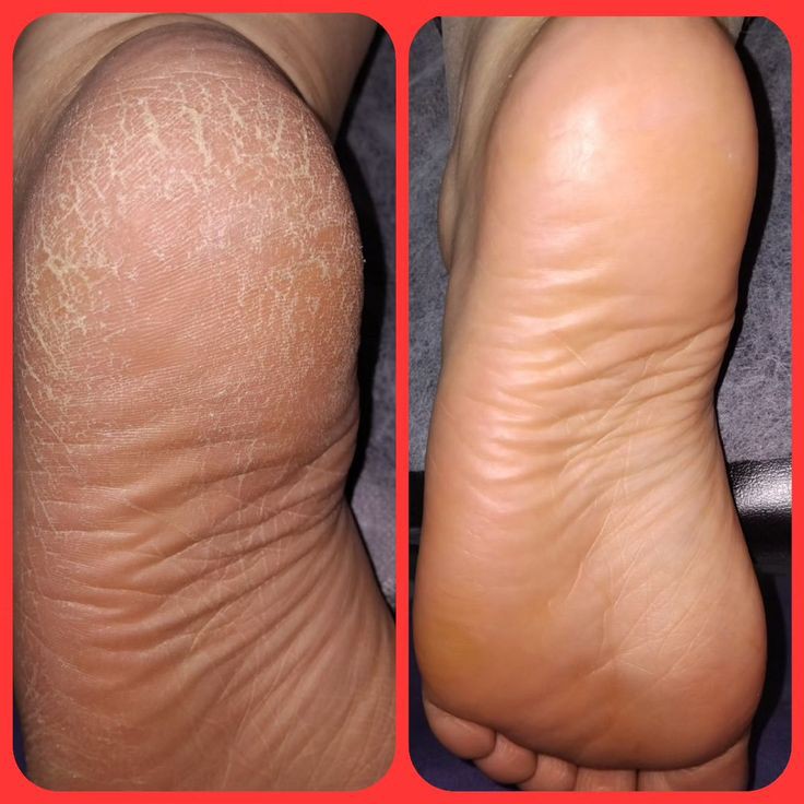کاشت ناخن پودر و ژل