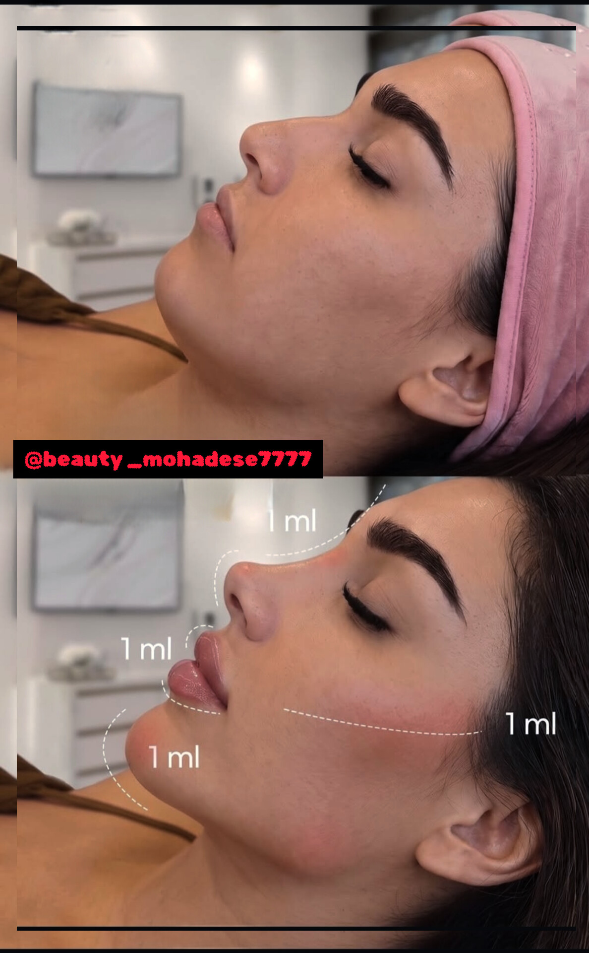تزریق ژل و بوتاکس .انزیم