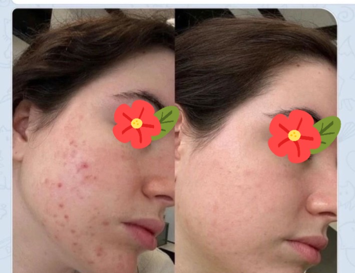 انجام خدمات پاک پوست و فیشیال