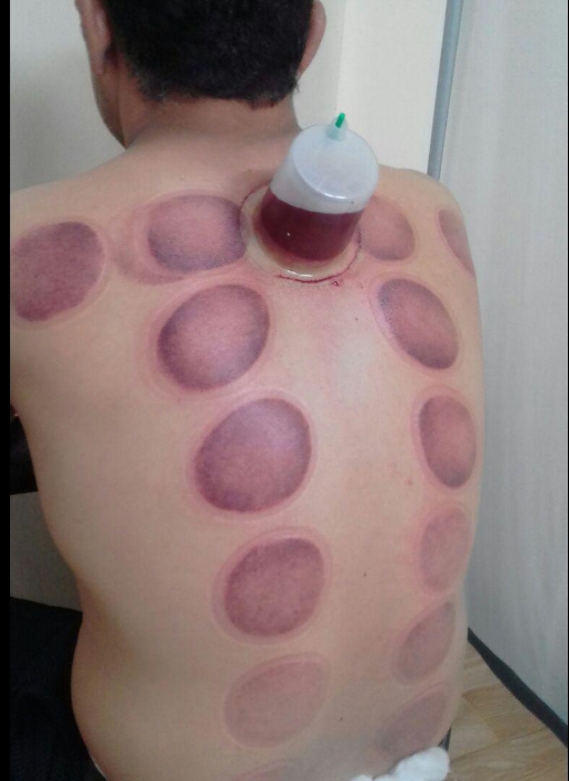 انجام انواع حجامت (چنارانی)