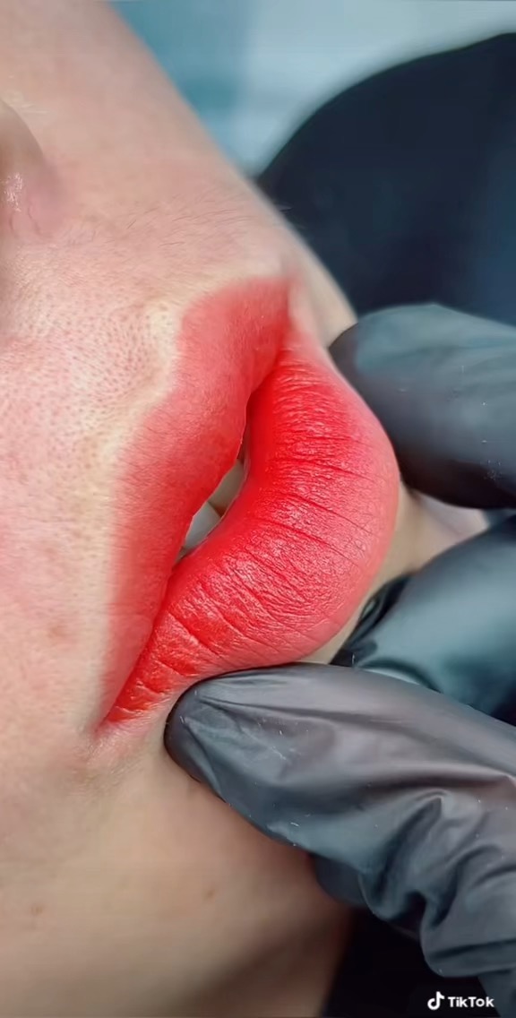 میکروبلیدینگ عسل علیزاده