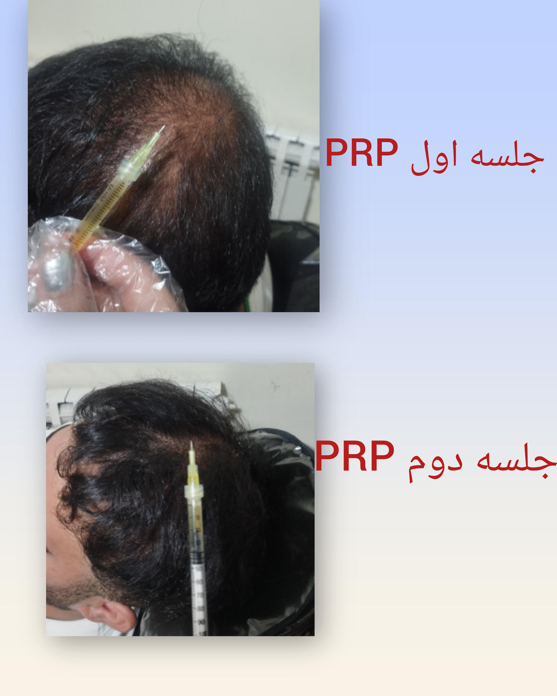 تخفیفات زیبایی PRP 850 توسط پزشک