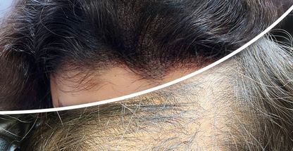 تتو دائم، فیبروز، میکروبلیدینگ و میکرو اسکالپ فهیمه سیوانی