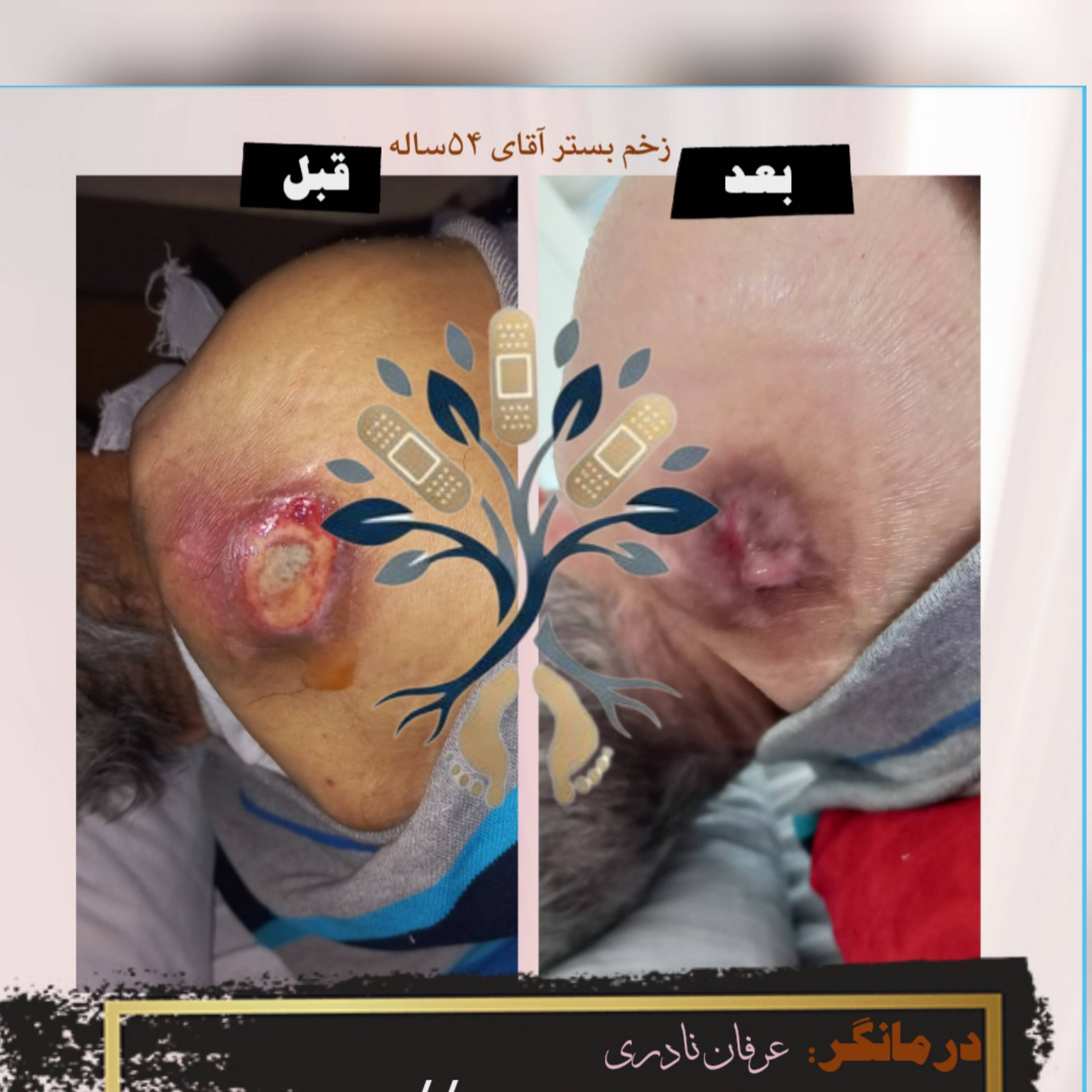 درمان زخم در منزل