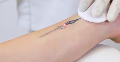 خدمات تخصصی ریمو تتو ایلدا