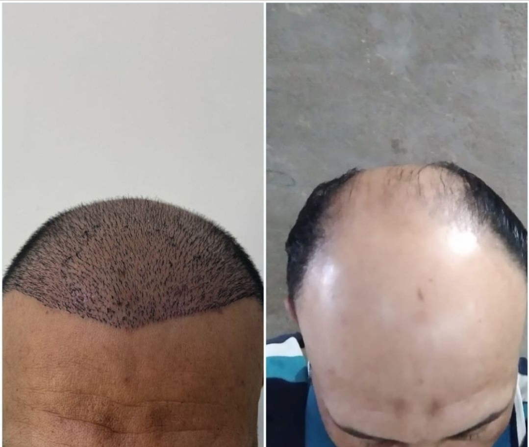 کاشت مو و ابرو