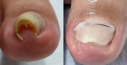 درمان ناخن فرو رفته در گوشت و پدیکور