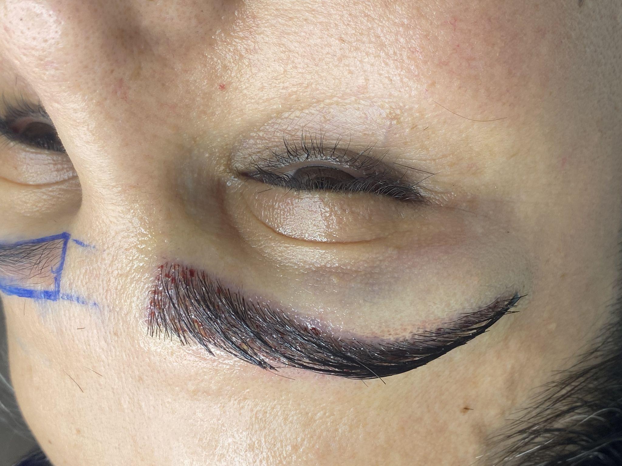 کاشت ابرو طبیعی دنیز