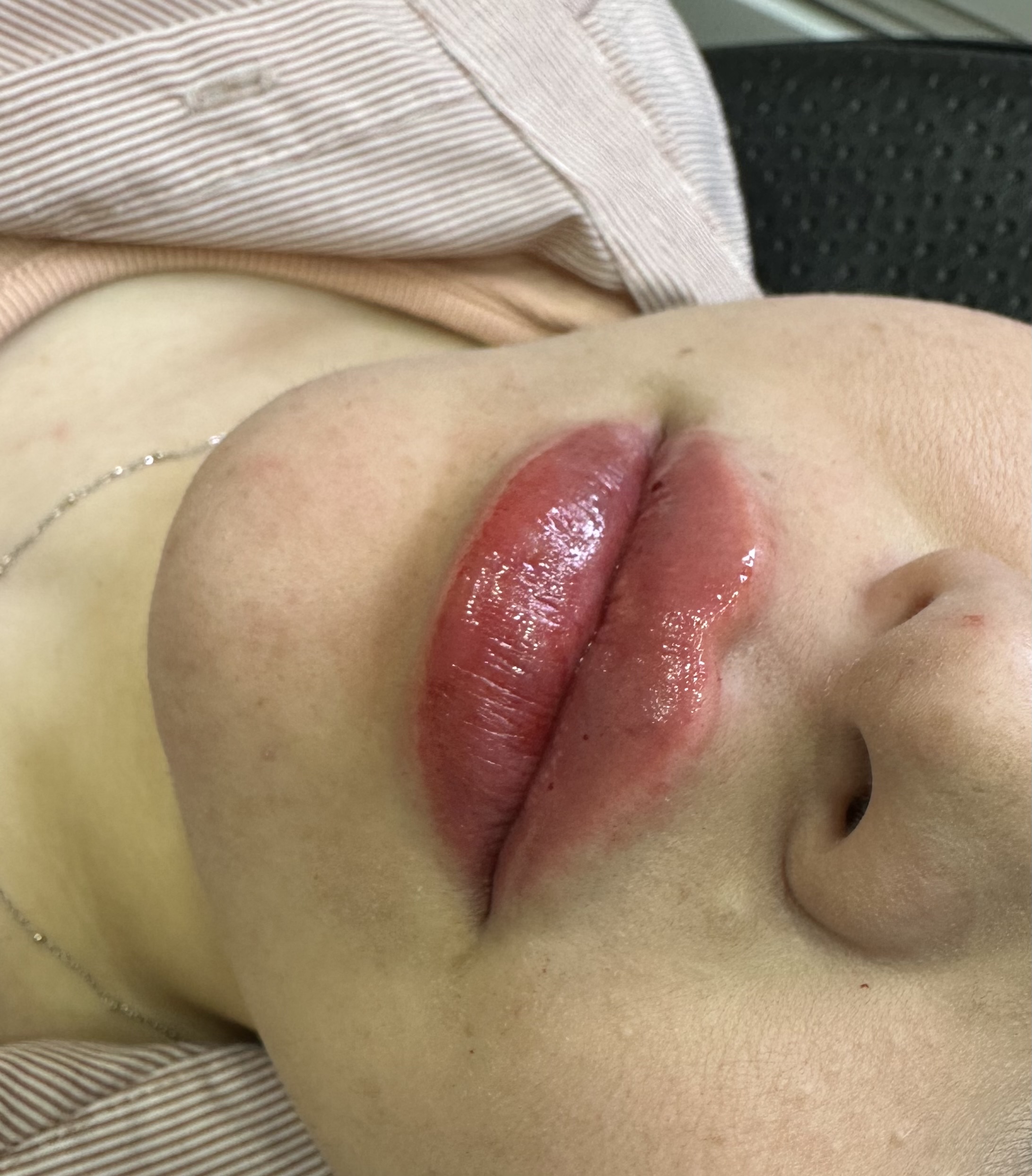 ژل و بوتاکس روشا