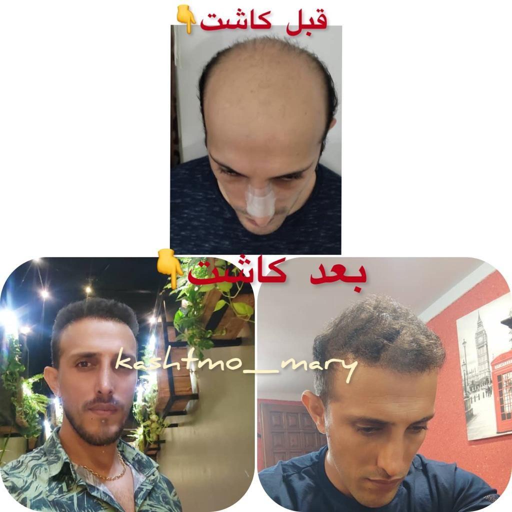 کاشت مو و ابرو