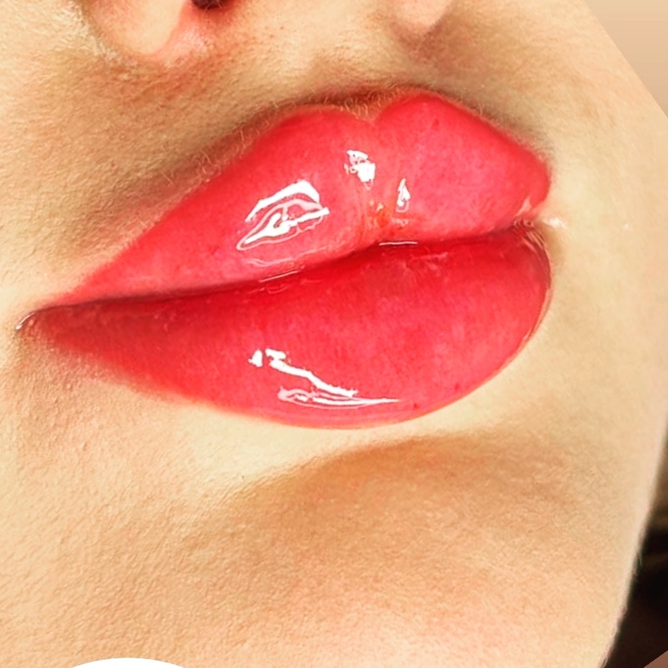 لیزر و ژل و بوتاکس پریناز