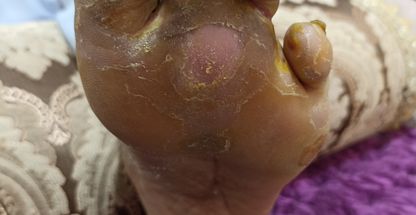 منصورشکوری، دکتر طب سننتی و درمانگر زخم