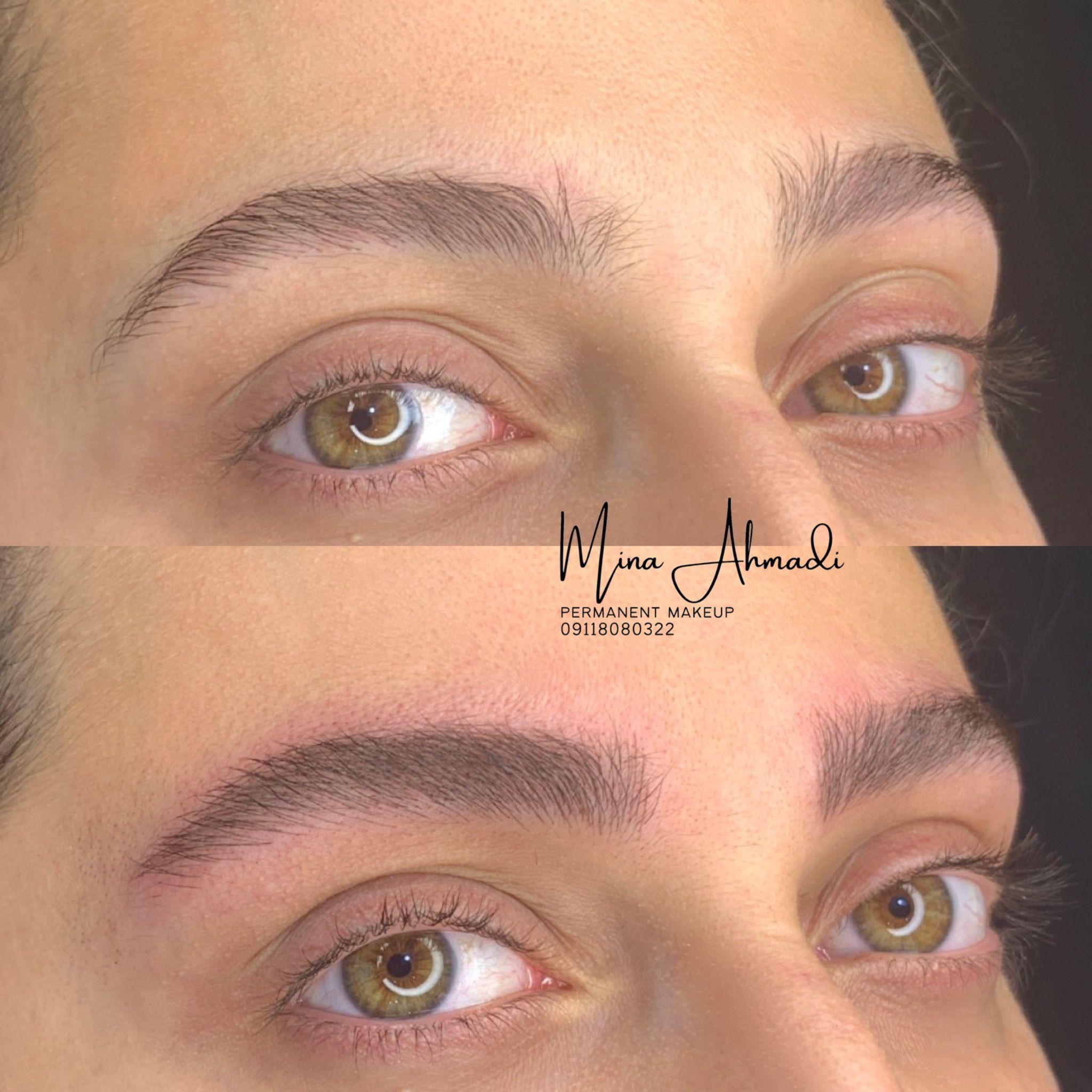 میکروبلیدینگ فیبروز مینا احمدی