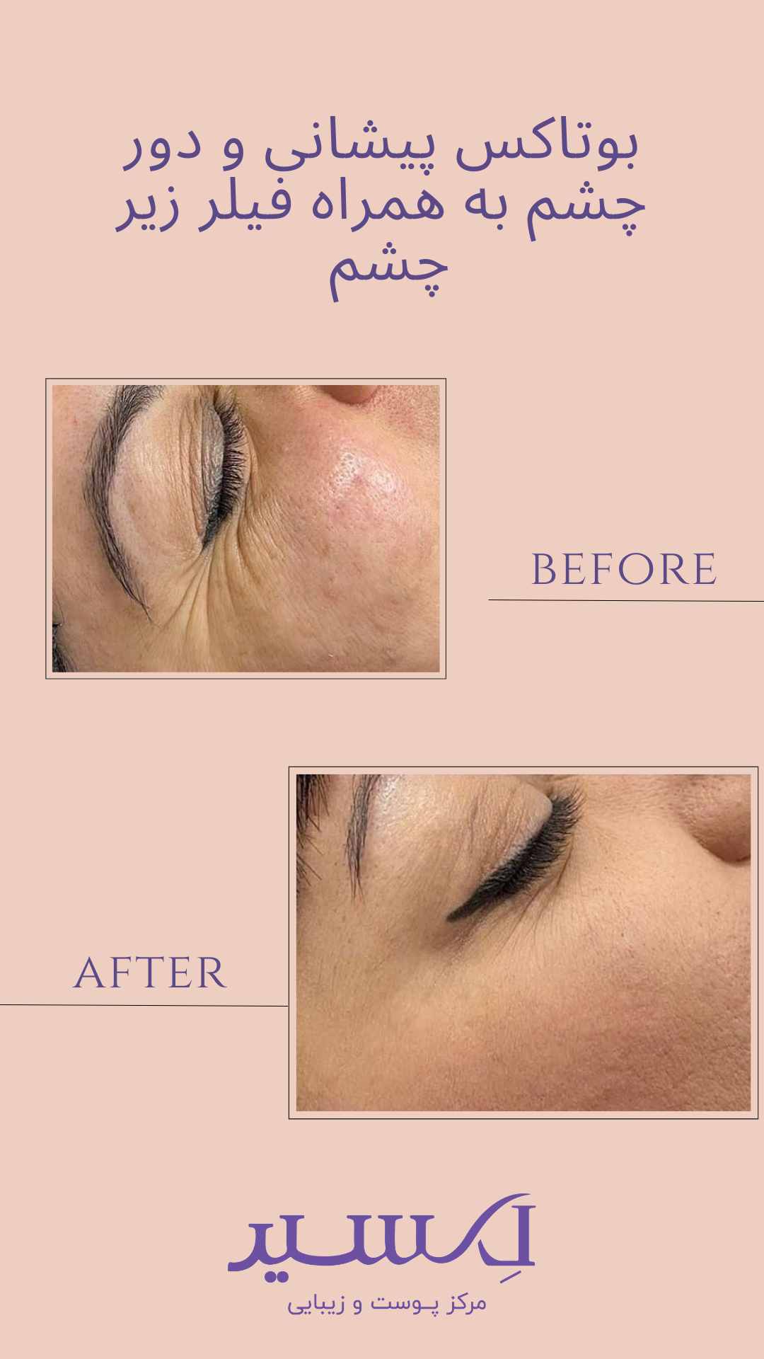 کلینیک لیزر هایفو اندولیفت لکسیر