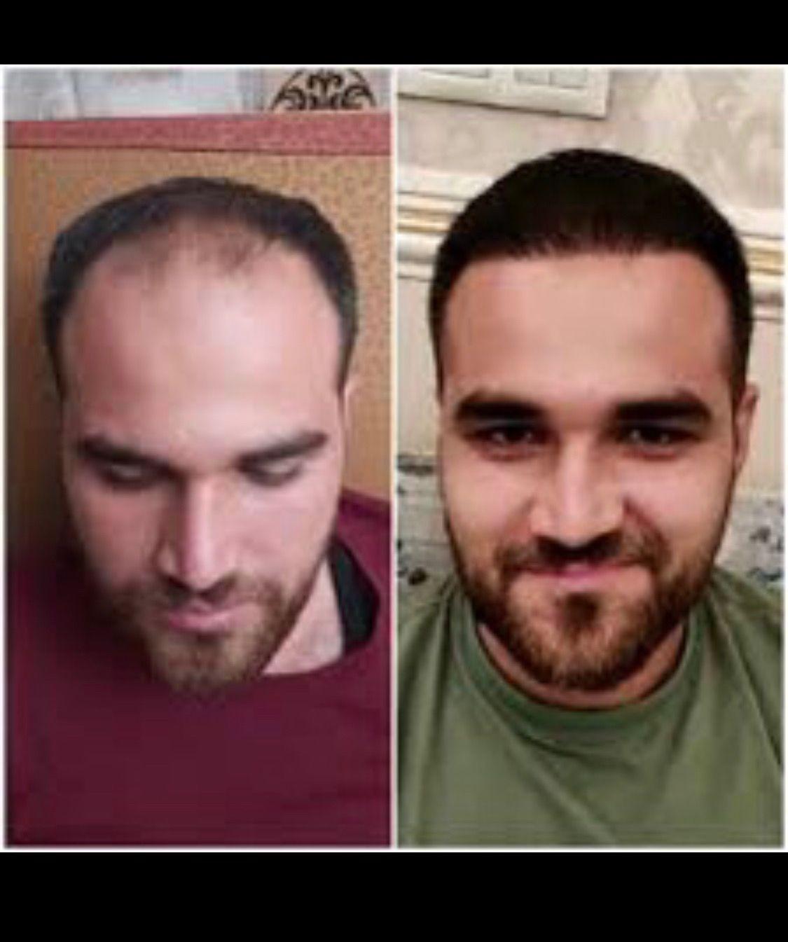 کاشت مو باقریان