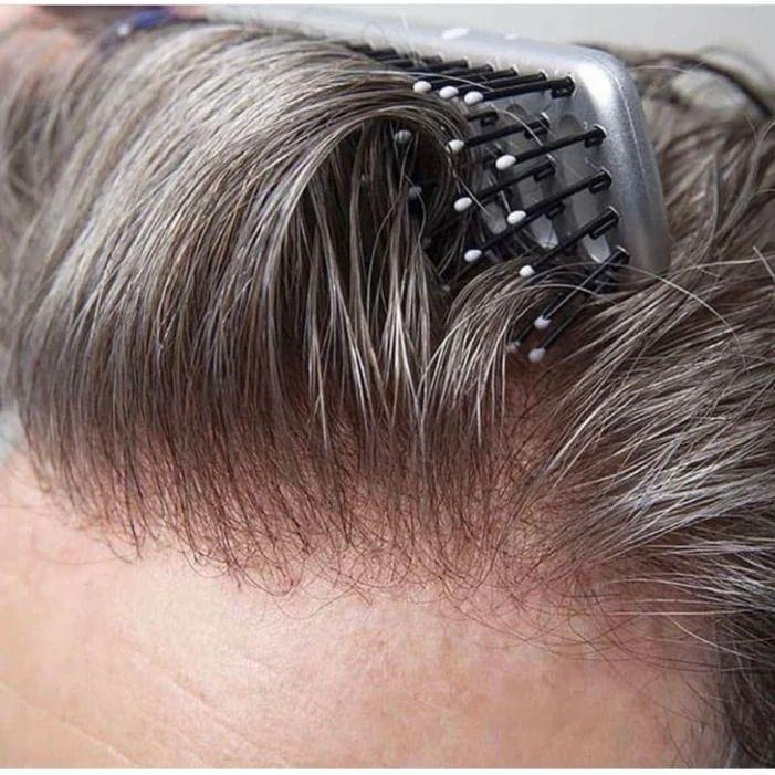 پروتز موی تیامسیس