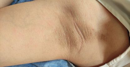 اپیلاسیون بوشهر