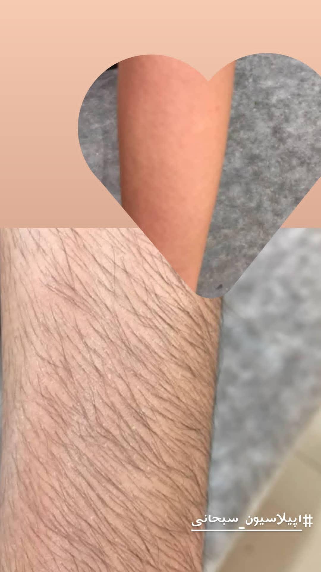 اپیلاسیون سبحانی