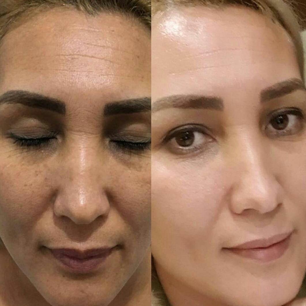 لاغری و لک پوست