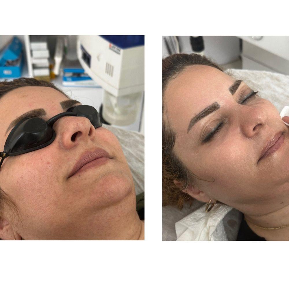 هایفو و جوانسازی