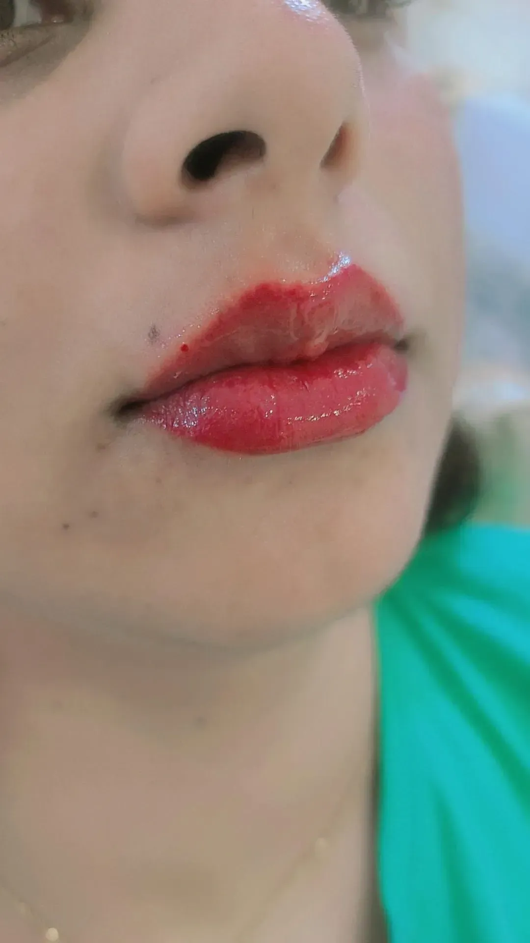 تزریق ژل و بوتاکس و مزوترواپی