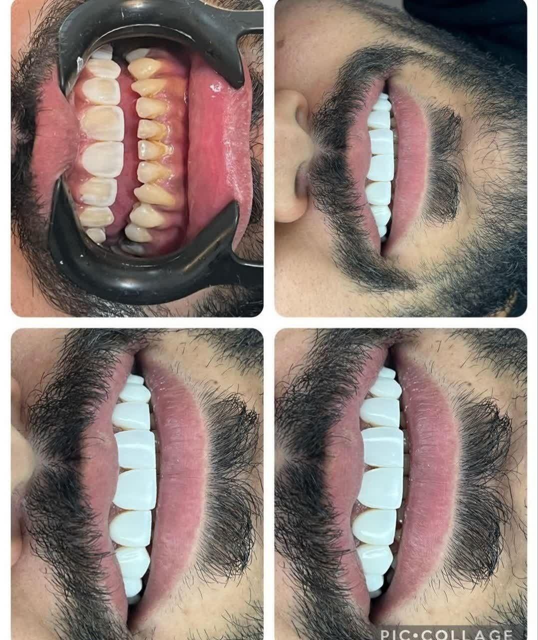 دندانپزشکی تاج دنتال