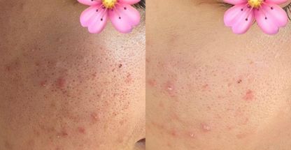 پاکسازی پوست نرگ