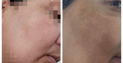 خدمات پاکسازی فیشال پوست