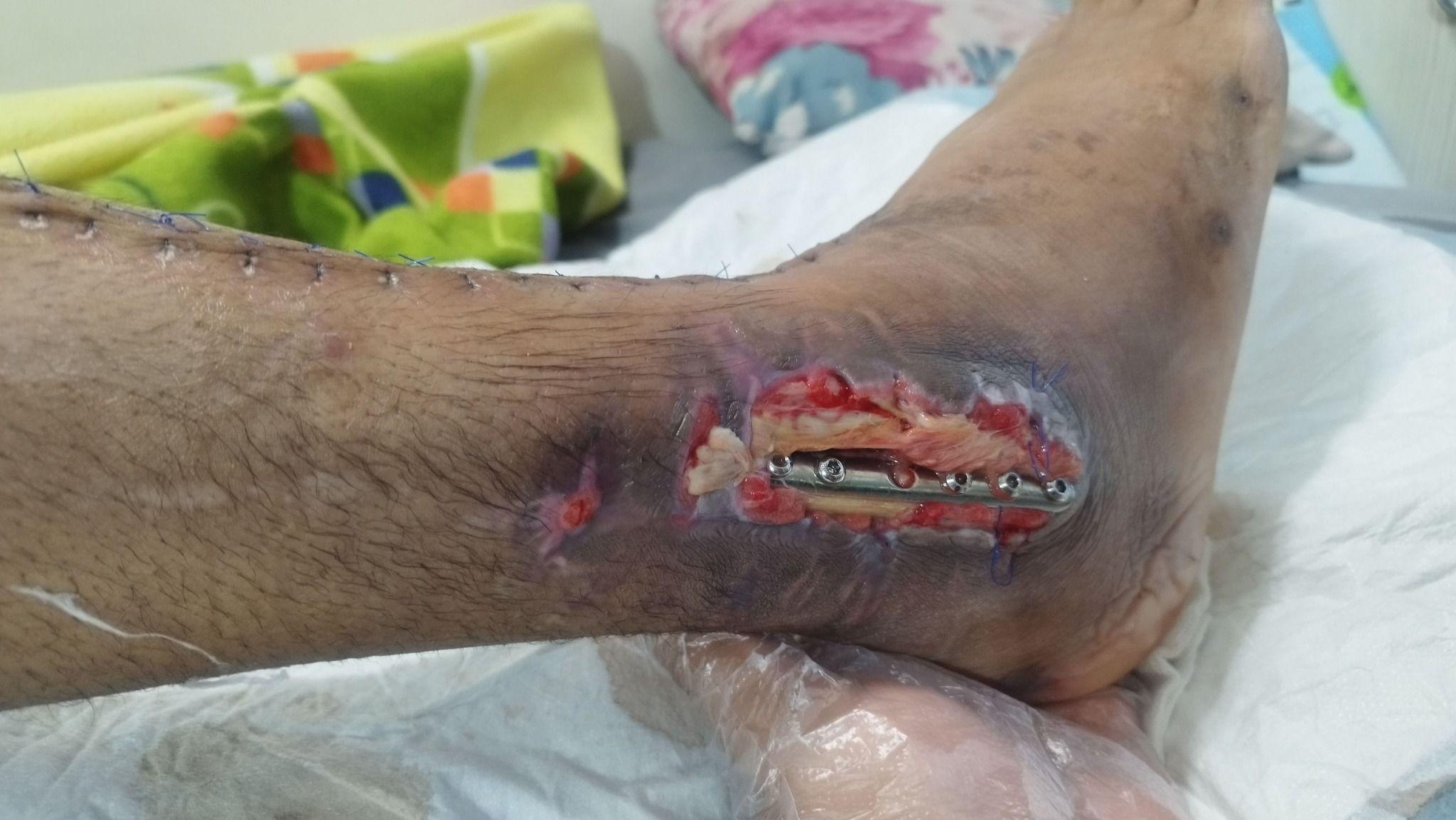 درمان زخم بستر و دیابت و تزریقات در منزل