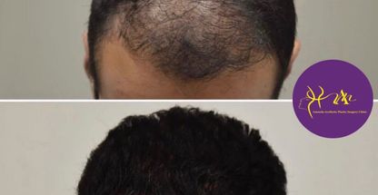 کاشت مو وابرو دکتر موسوی