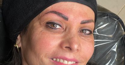 میکروبلیدینگ و میکروپیگمنتیشن سونیا