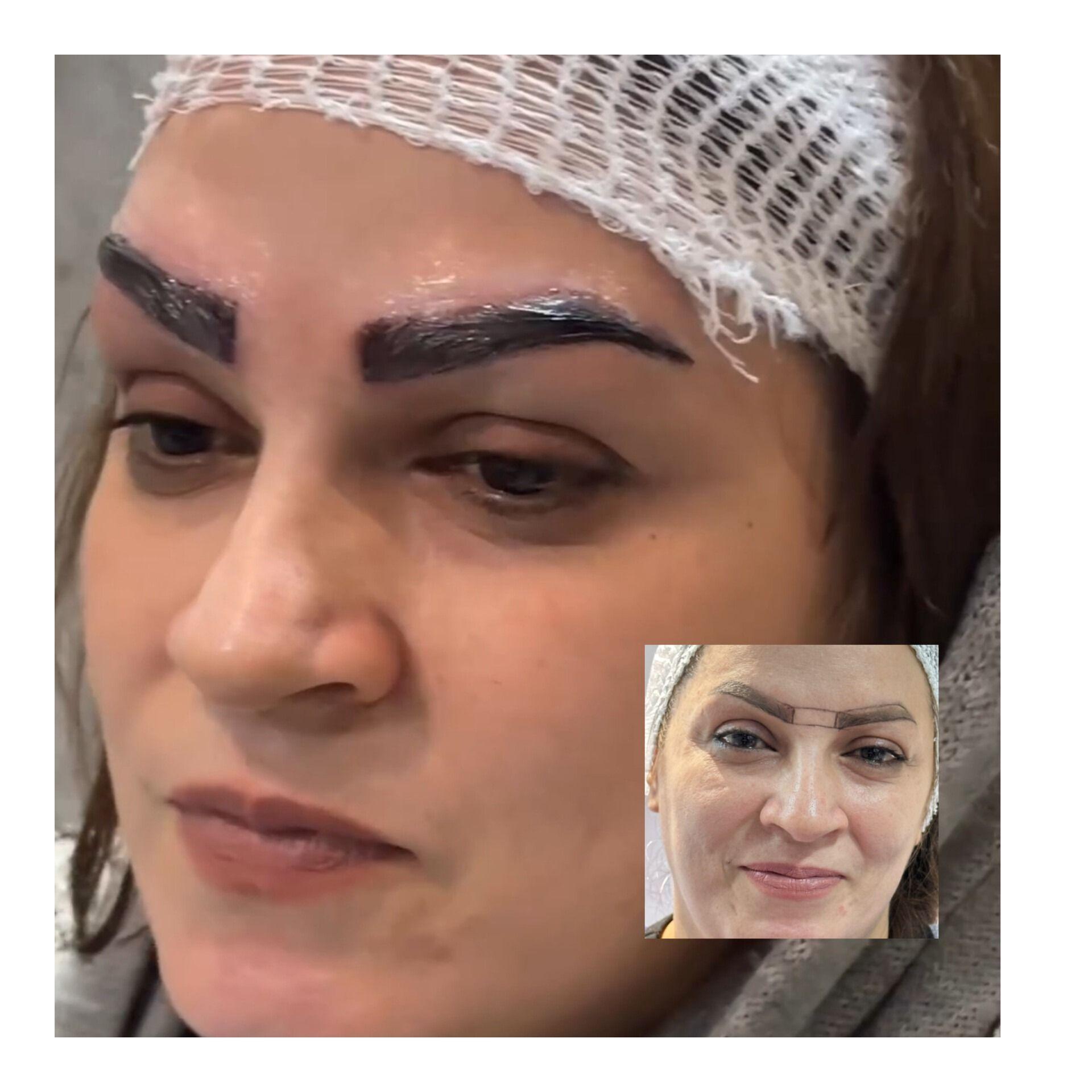 کاشت ابرو و موی باران