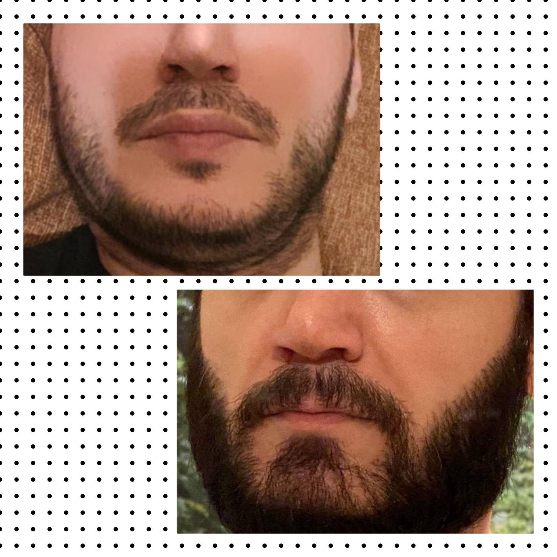 کاشت مو و ابرو کرج