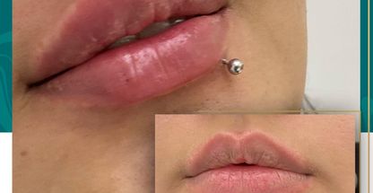 کلینیک تزریق بوتاکس و فیلر نارینا