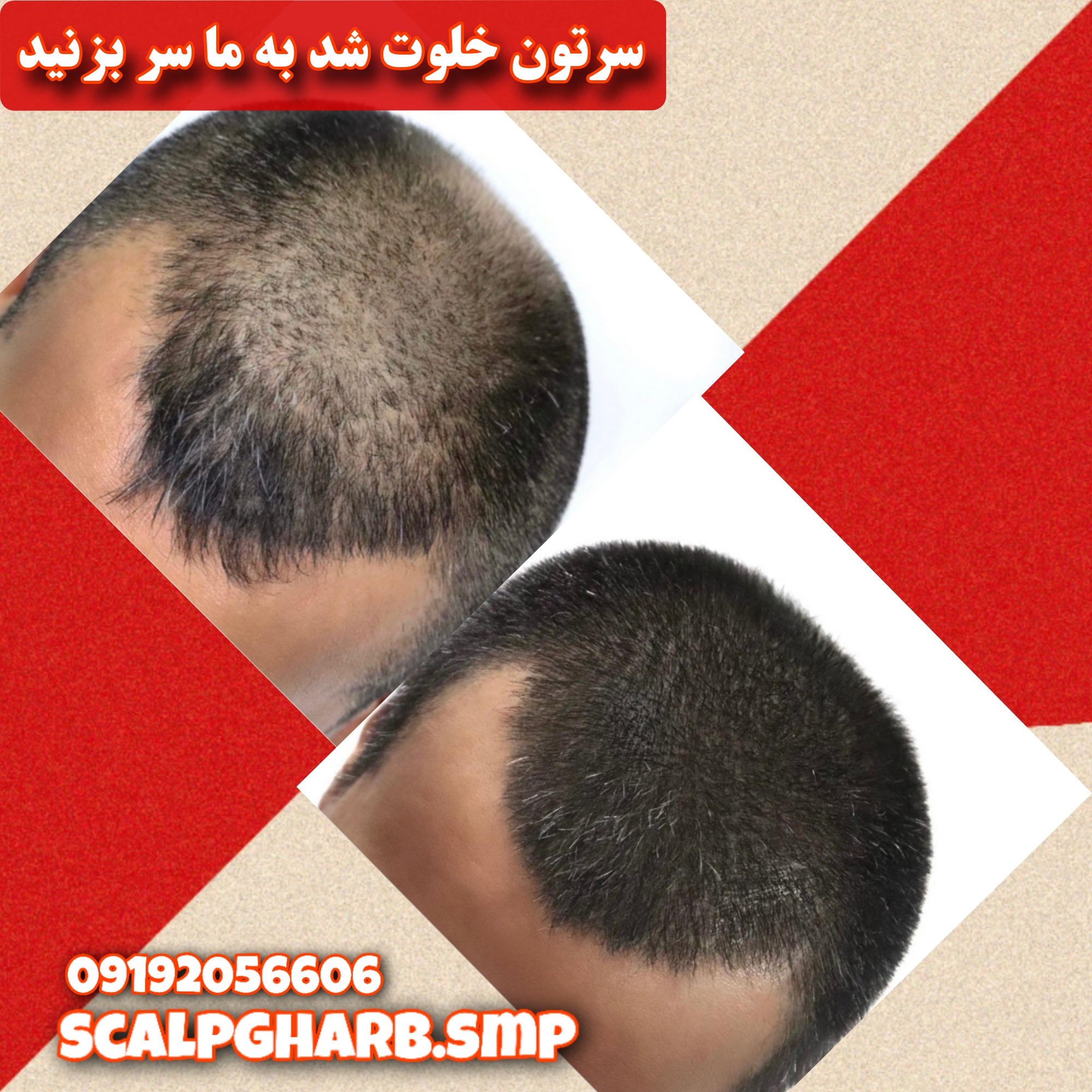 رفع کمپشتی موها با میکرواسکالپ