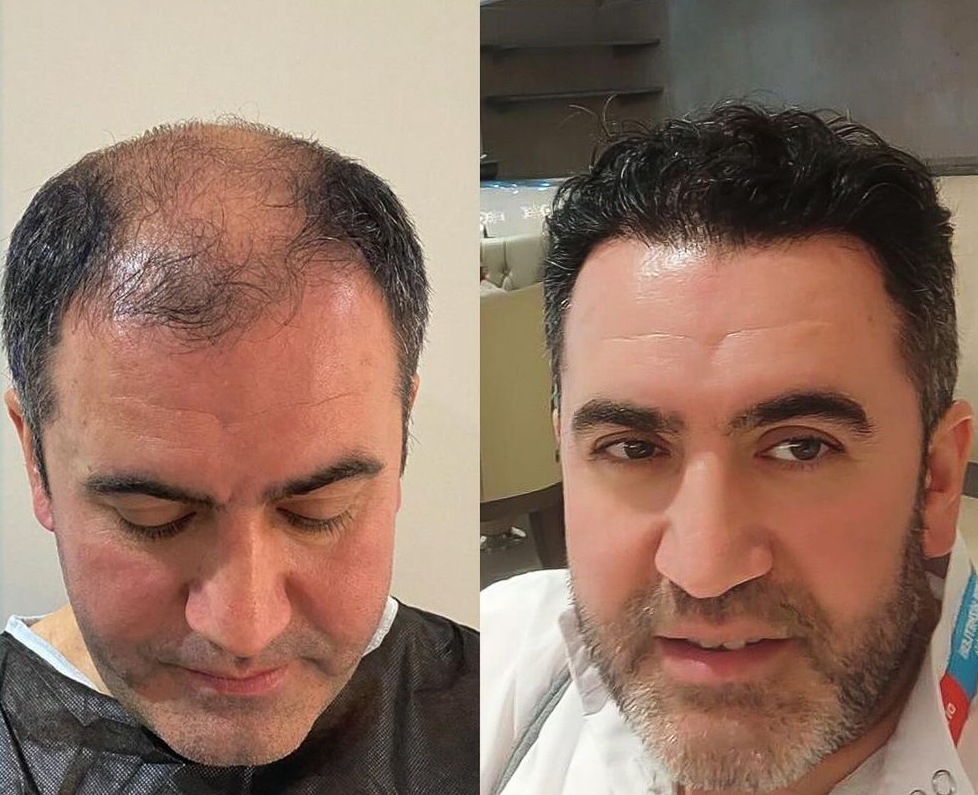 کاشت مو شهریار