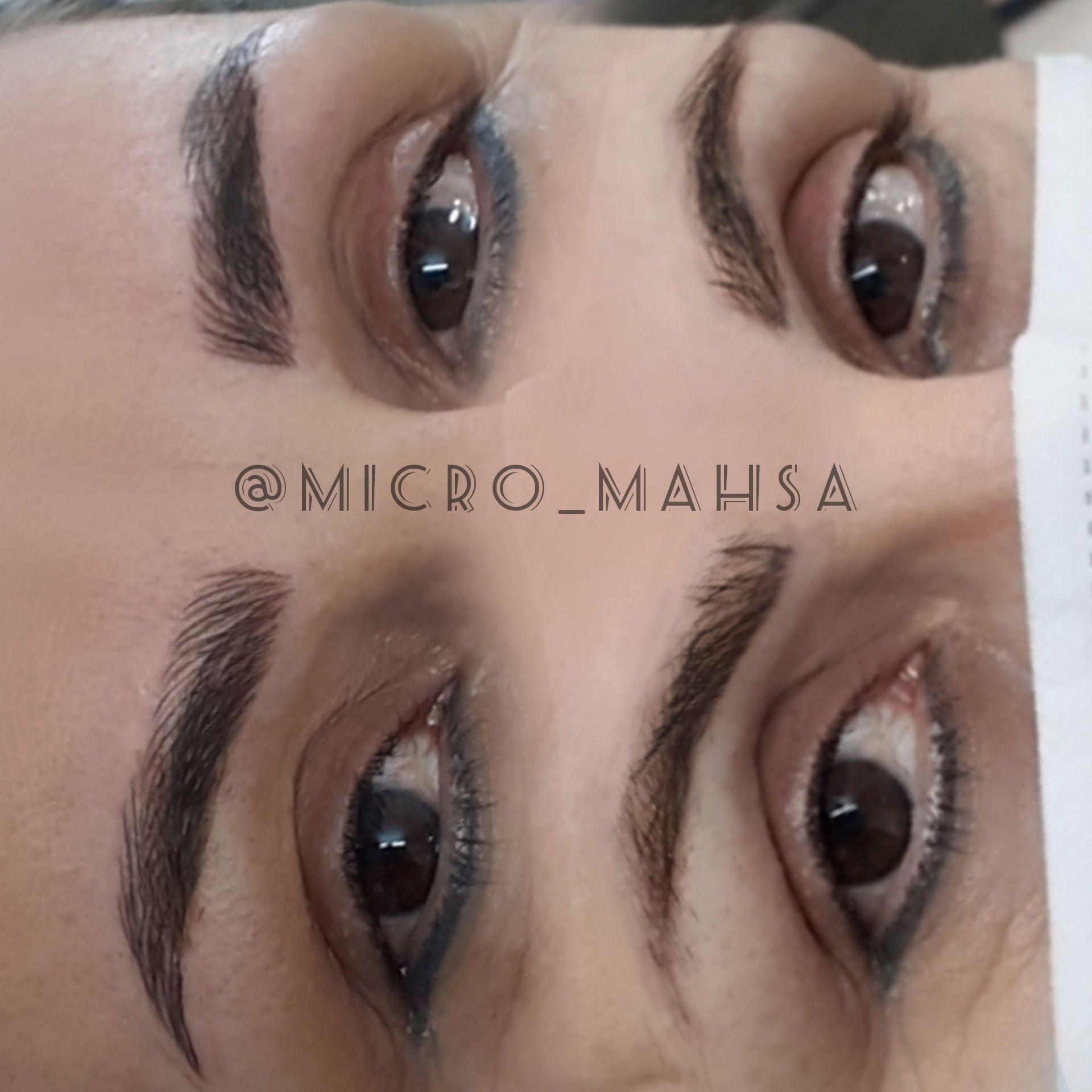 Micro_mahsa  میکروبلیدینگ فیبروز