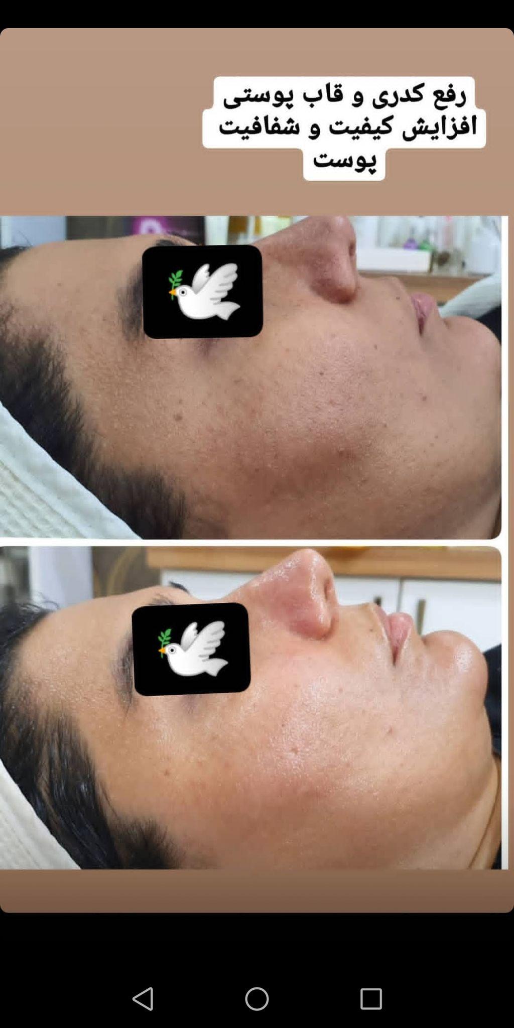 فشیال و پاکسازی پوست طهماسبی